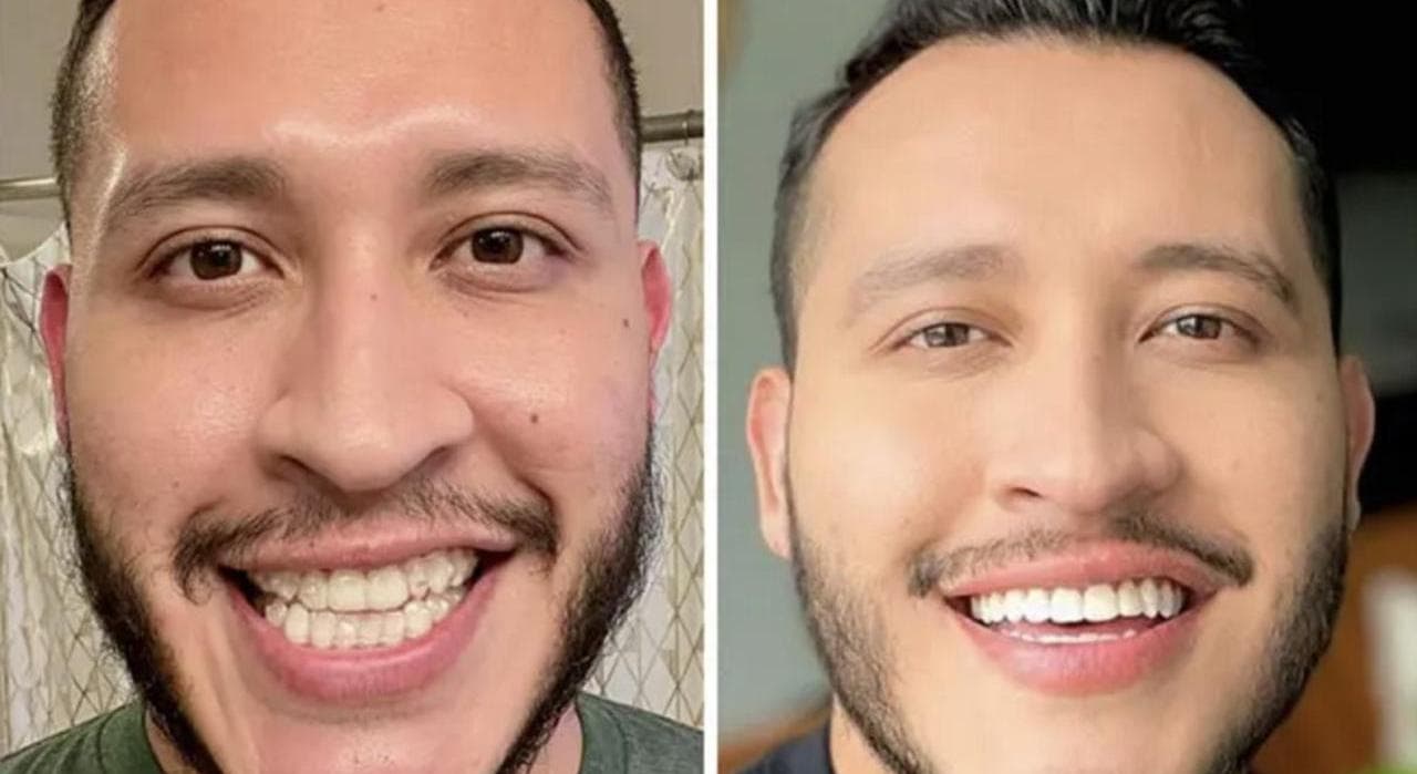 Invisalign · Alignment — before and after result