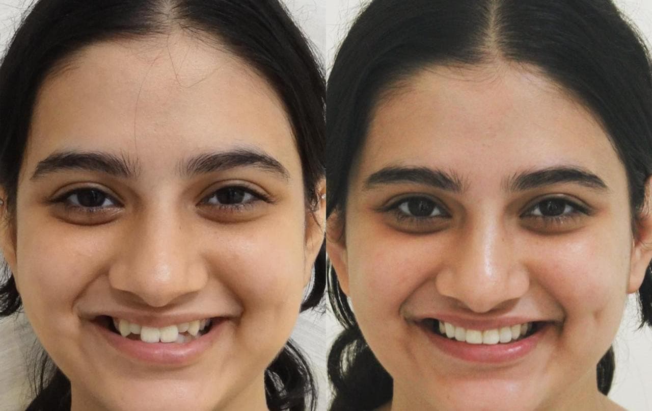 Full Smile Makeover — before and after result